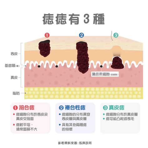 痣為什麼會凸起來|痣形成的原因？痣長毛、痣變多變大是痣病變？5招判。